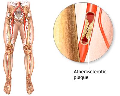 Best doctor for peripheral artery disease