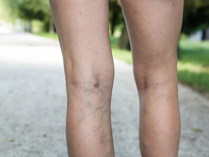 varicose veins