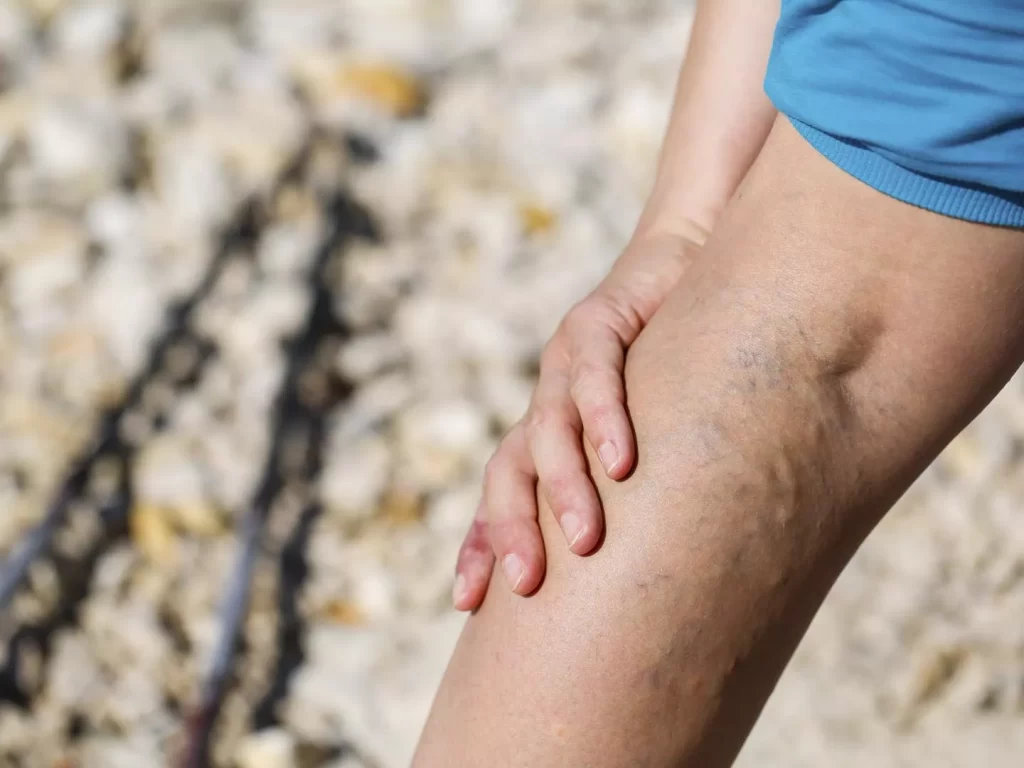 varicose veins