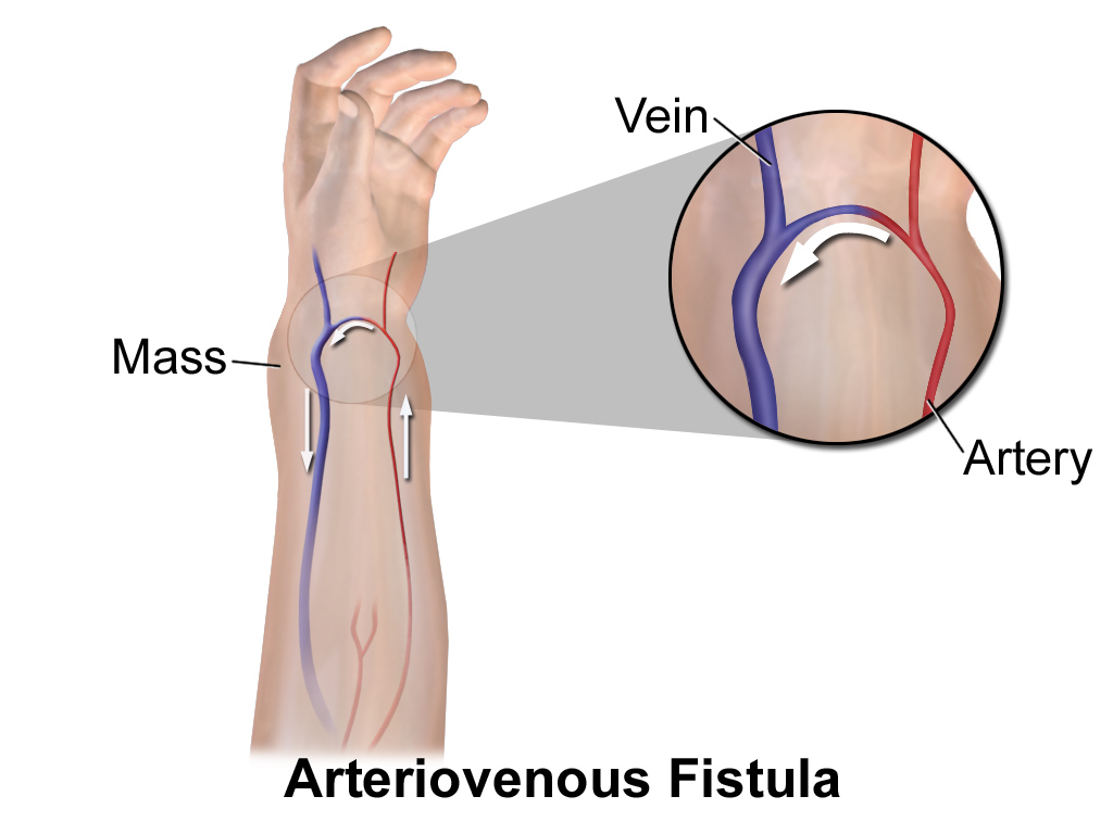 What is an Arteriovenous