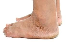 Diabetic Foot Problems